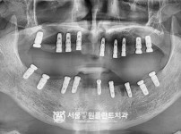 뼈이식 네비게이션 18개_오스템 치료 후