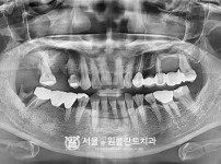 발치 후 즉시식립 4개 - 오스템 치료 전