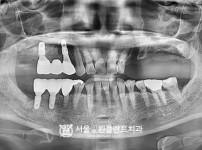 발치 후 즉시식립 4개 - 오스템 치료 후