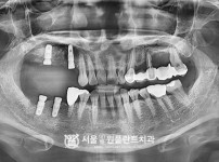 발치 후 즉시식립 4개 - 오스템 치료 전