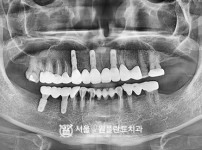발치 즉시 식립 뼈이식 임플란트 5개 - 오스템 치료 후