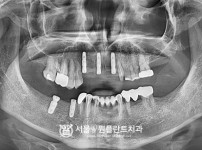 발치 즉시 식립 뼈이식 임플란트 5개 - 오스템 치료 전