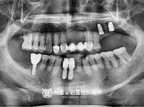 잘못 식립된 임플란트 제거 후 즉시 식립 2개 - 네오 치료 후