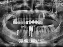 잘못 식립된 임플란트 제거 후 즉시 식립 2개 - 네오 치료 전