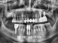잘못 식립된 임플란트 제거 후 즉시 식립 2개 - 네오 최종 치료 후