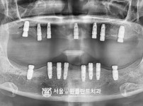 발치 즉시 식립 네이비게이션 임플란트 15개- 네오 치료 후