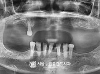 발치 즉시 식립 네이비게이션 임플란트 15개- 네오 치료 전