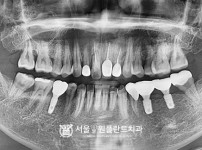 임플란트 3개 - 오스템 치료 후
