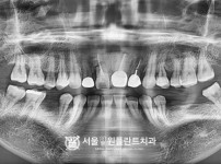 임플란트 3개 - 오스템 치료 전