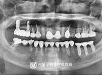 뼈이식 임플란트 2개 - 오스템 치료 후