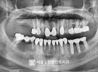 뼈이식 임플란트 2개 - 오스템 치료 전