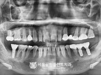 원데이 임플란트 2개 - 오스템 치료 후