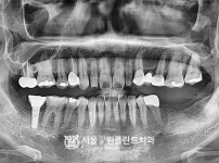 원데이 임플란트 2개 - 오스템 치료 전