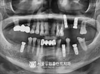 발치 후 즉시 식립 5개 - 오스템 치료 후