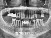 발치 후 즉시 식립 5개 - 오스템 치료 전