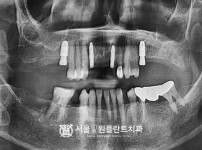 발치 후 즉시 식립 4개 - 오스템 치료 후